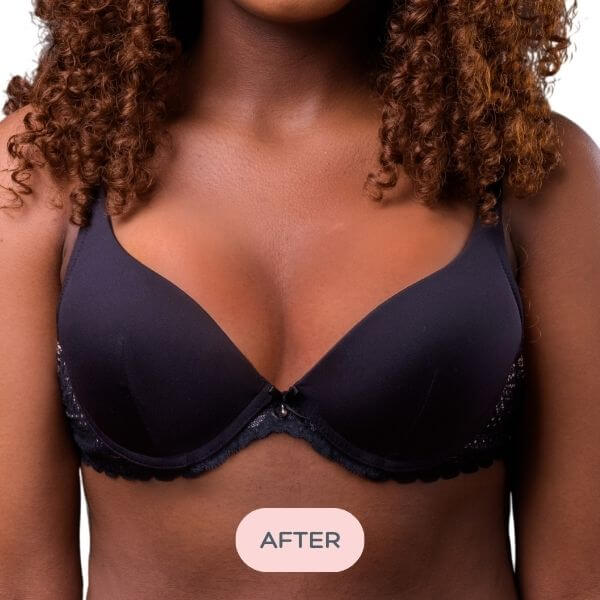 Black bra with breast insert worn by a model with 'AFTER' label on a white background
