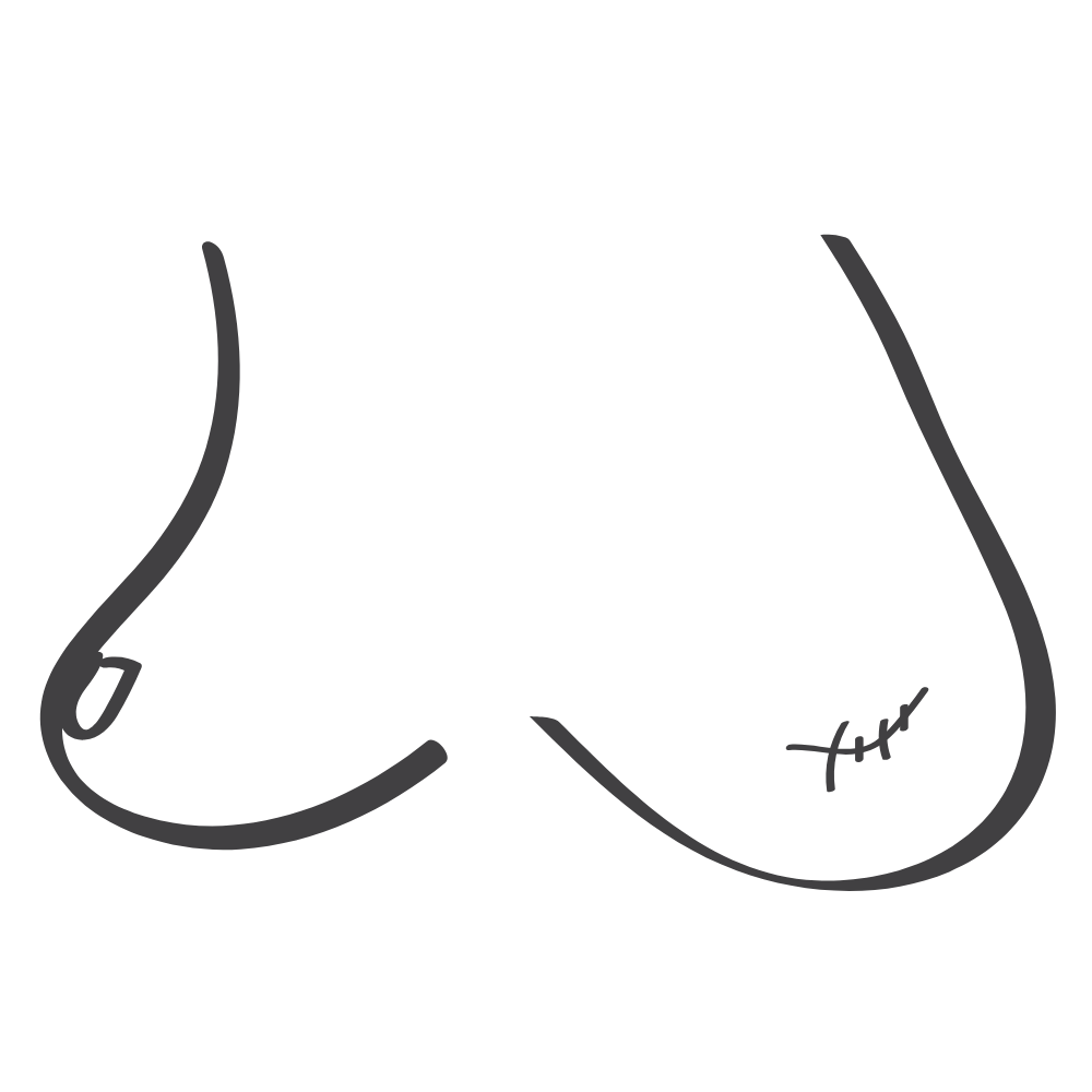 Breast Asymmetry Post Surgery Illustration