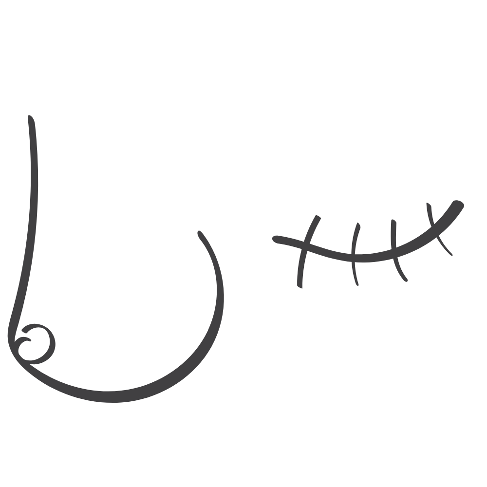 Masectomy Breast Asymmetry Illustration