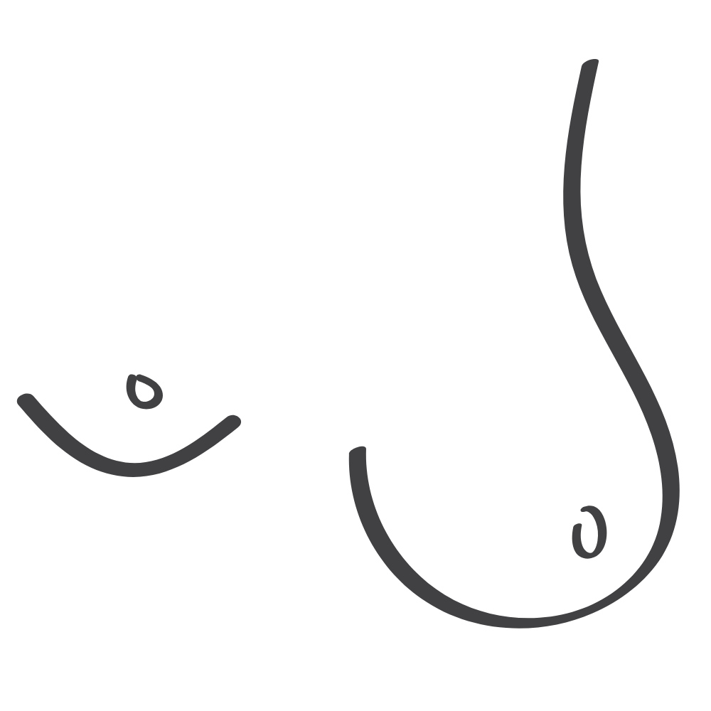 Poland Syndrome Breast Asymmetry illustration