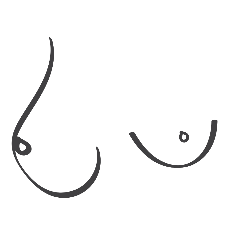 pregnancy breast asymmetry illustration