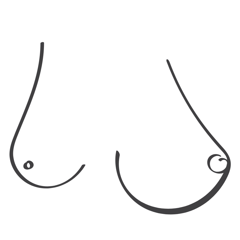 Scoliosis Breast Asymmetry illustration