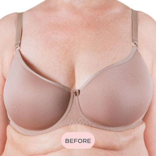 Silicone Breast Forms Asymmetry - Before